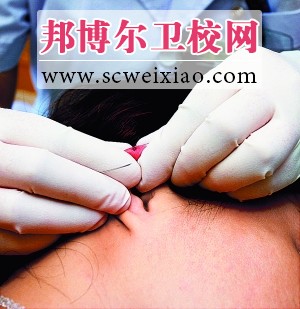 针刺放血疗法知识五步骤