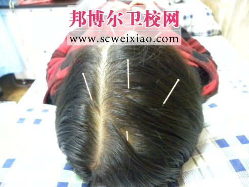 如何利用针灸治疗偏头痛