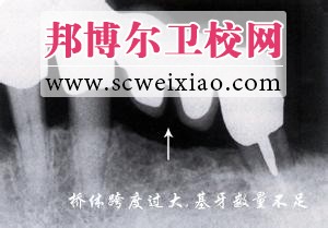 桥基牙