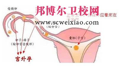 护士资格考试之宫外孕考点内容